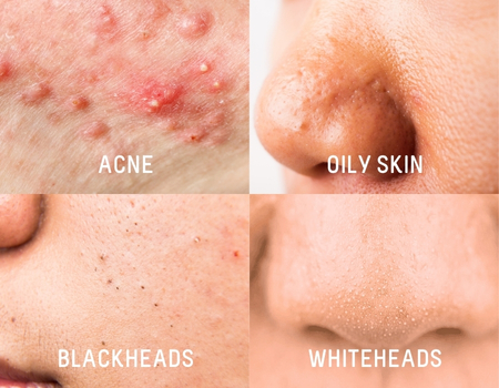Generation Flawless: Your Best Ally Against Teen Skin Woes